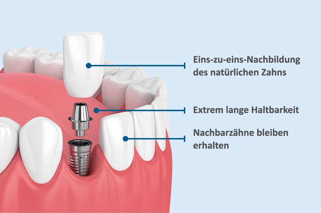 Implantate Dresden - im AllDent Implantatzentrum